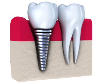 Intrebari si raspunsuri despre implantul dentar