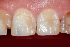 Eroziunea dentara